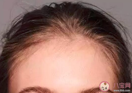 不经意让发际线后移的习惯有哪些 怎样让发际线不继续后移 不经意让发际线后移的习惯有哪些 怎样让发际线不继续后移