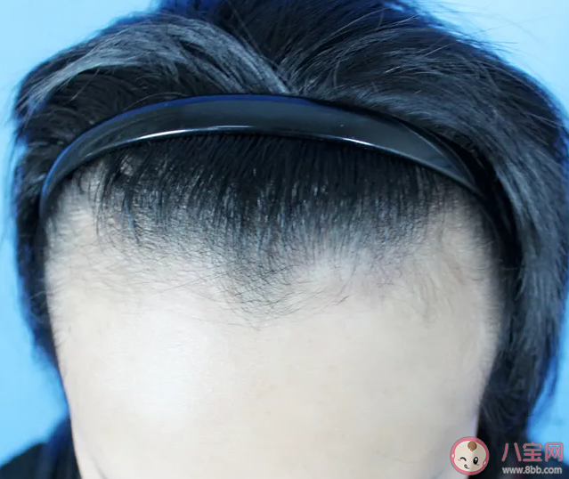 不经意让发际线后移的习惯有哪些 怎样让发际线不继续后移 不经意让发际线后移的习惯有哪些 怎样让发际线不继续后移