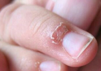 10个月宝宝食指倒刺被拔送PICU抢救是怎么回事 手指倒刺能随便拔吗