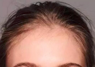 不经意让发际线后移的习惯有哪些 怎样让发际线不继续后移