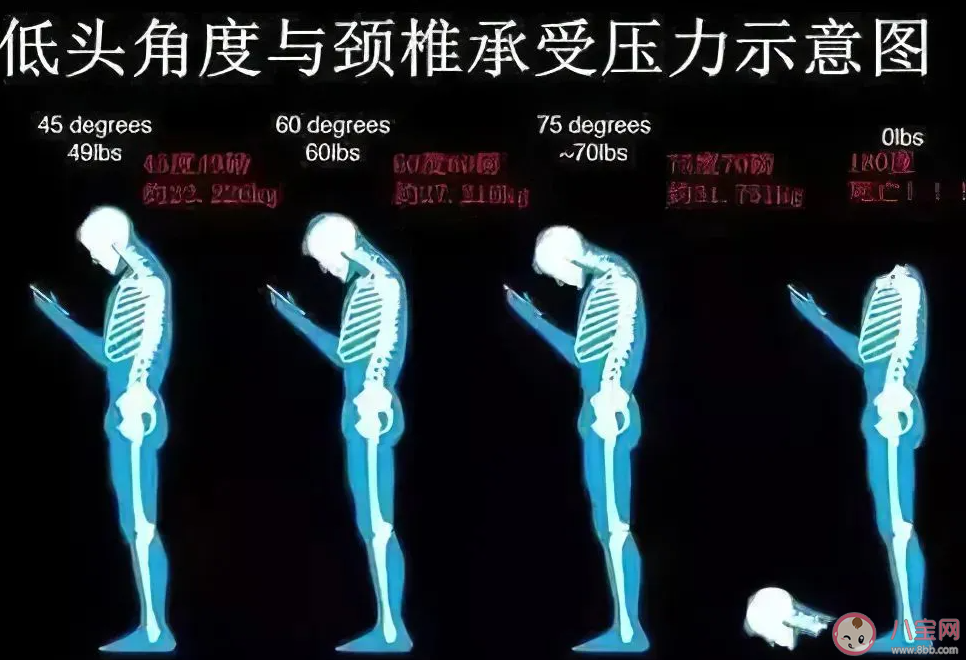 17岁高中生颈椎后凸堪比47岁是怎么回事 颈椎后凸该怎么办 17岁高中生颈椎后凸堪比47岁是怎么回事 颈椎后凸该怎么办