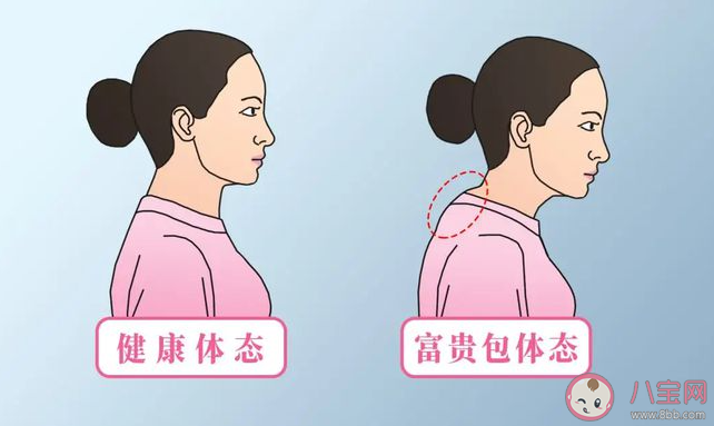 17岁高中生颈椎后凸堪比47岁是怎么回事 颈椎后凸该怎么办 17岁高中生颈椎后凸堪比47岁是怎么回事 颈椎后凸该怎么办