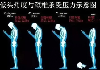 17岁高中生颈椎后凸堪比47岁是怎么回事 颈椎后凸该怎么办
