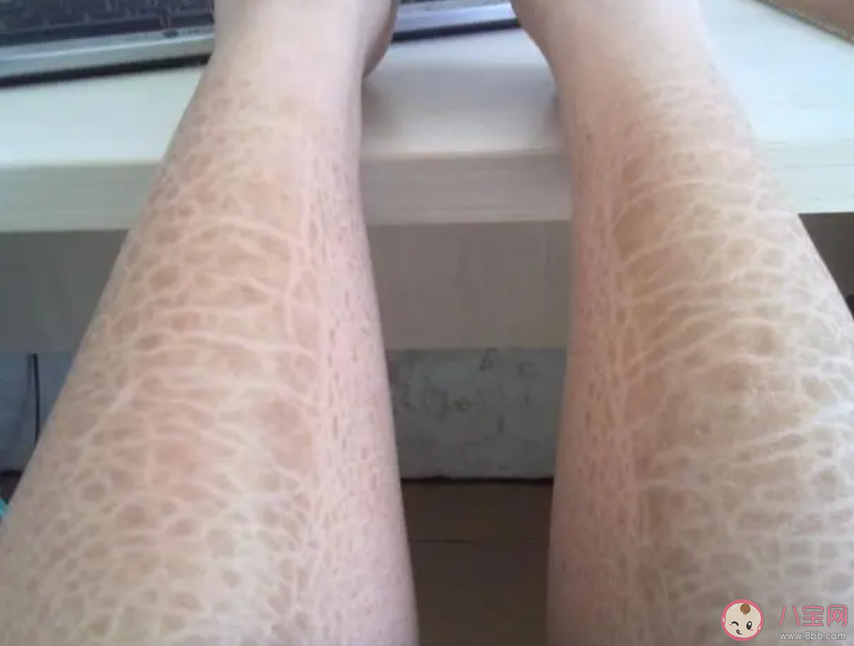 蛇皮腿是怎么一回事 怎样护理蛇皮腿