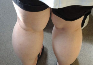 研究发现大腿粗的人更长寿 大腿粗可以怎么减